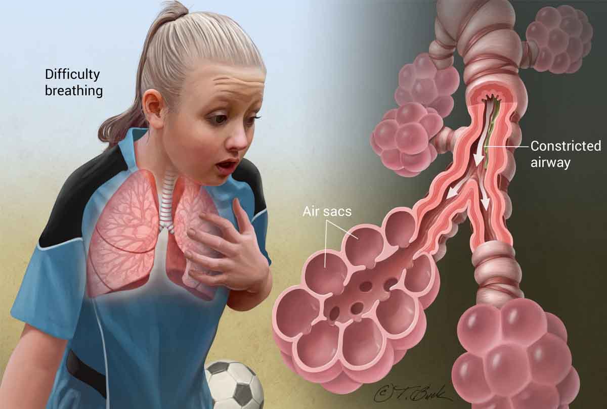 asthma 1
